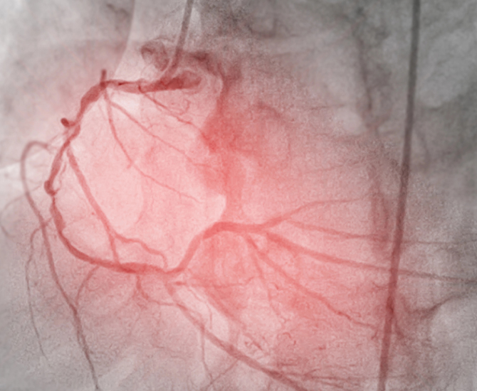 Coronary Angiogram Rendering in Rockland County, NY's Cardiologist Office